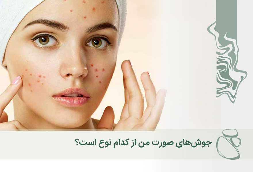 جوش‌های صورت من از کدام نوع است؟